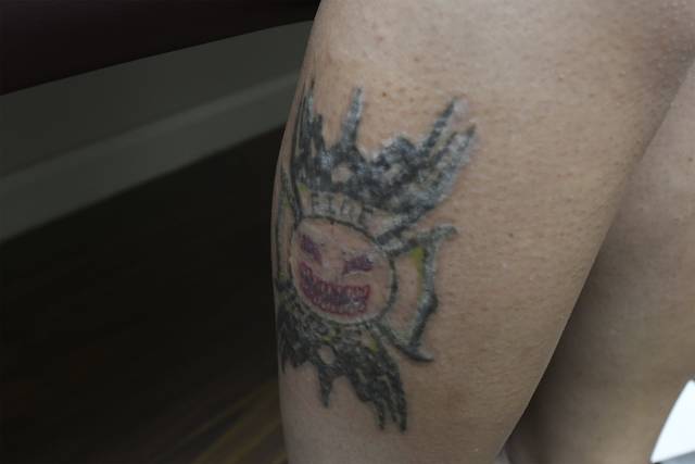 1402824_web1_VND-TattooRemovel4-072219