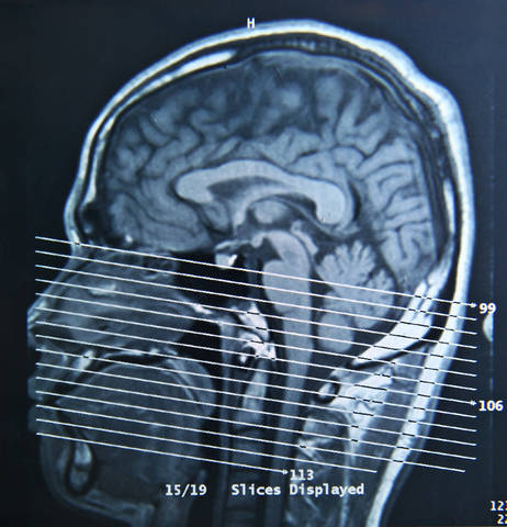 1511439_web1_Concussion-brain
