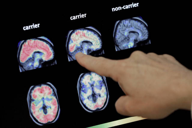 Drugs fail to slow decline in inherited Alzheimer’s disease