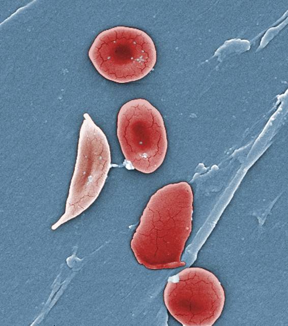 2385304_web1_web-sicklecell